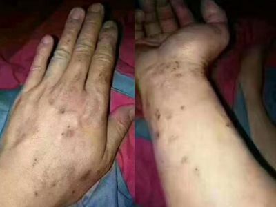 使用劣質(zhì)真瓷膠做美縫，后果自負(fù)！